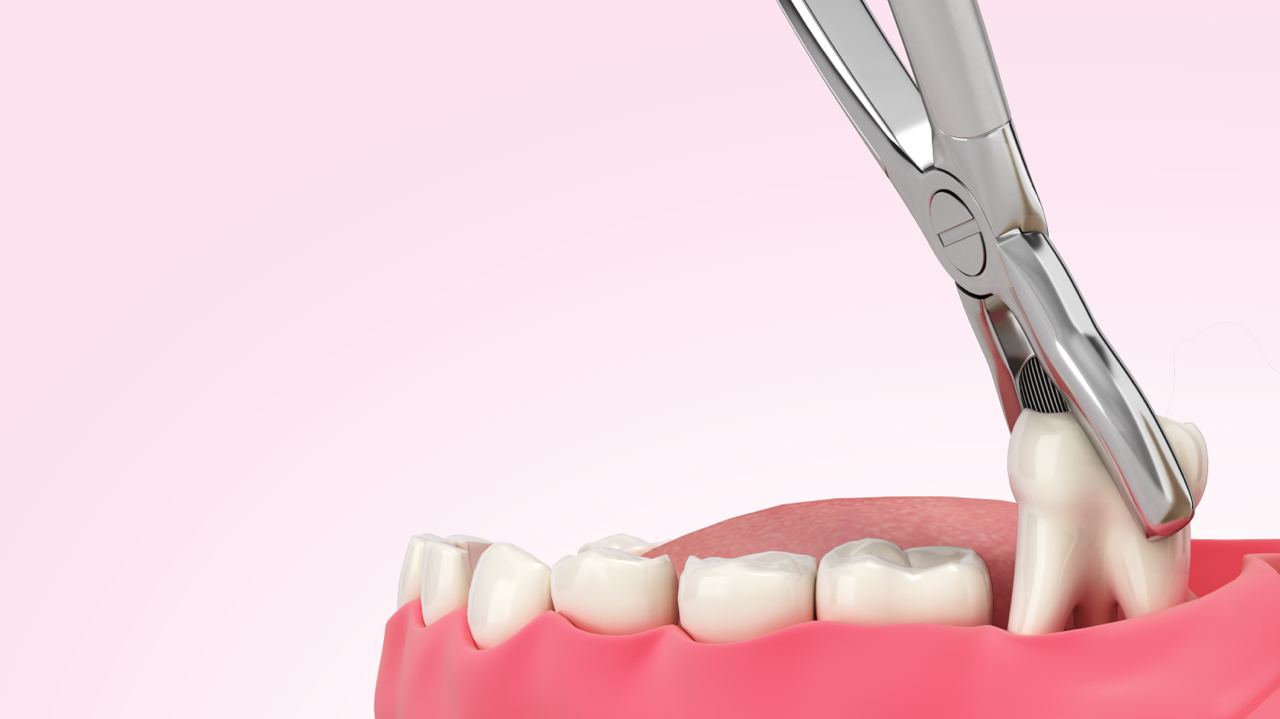 tooth extraction in Surrey, BC