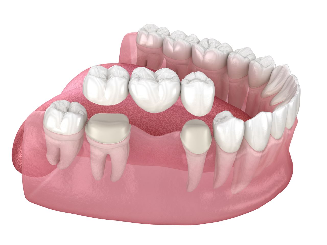 3d render dental bridge in Surrey, BC