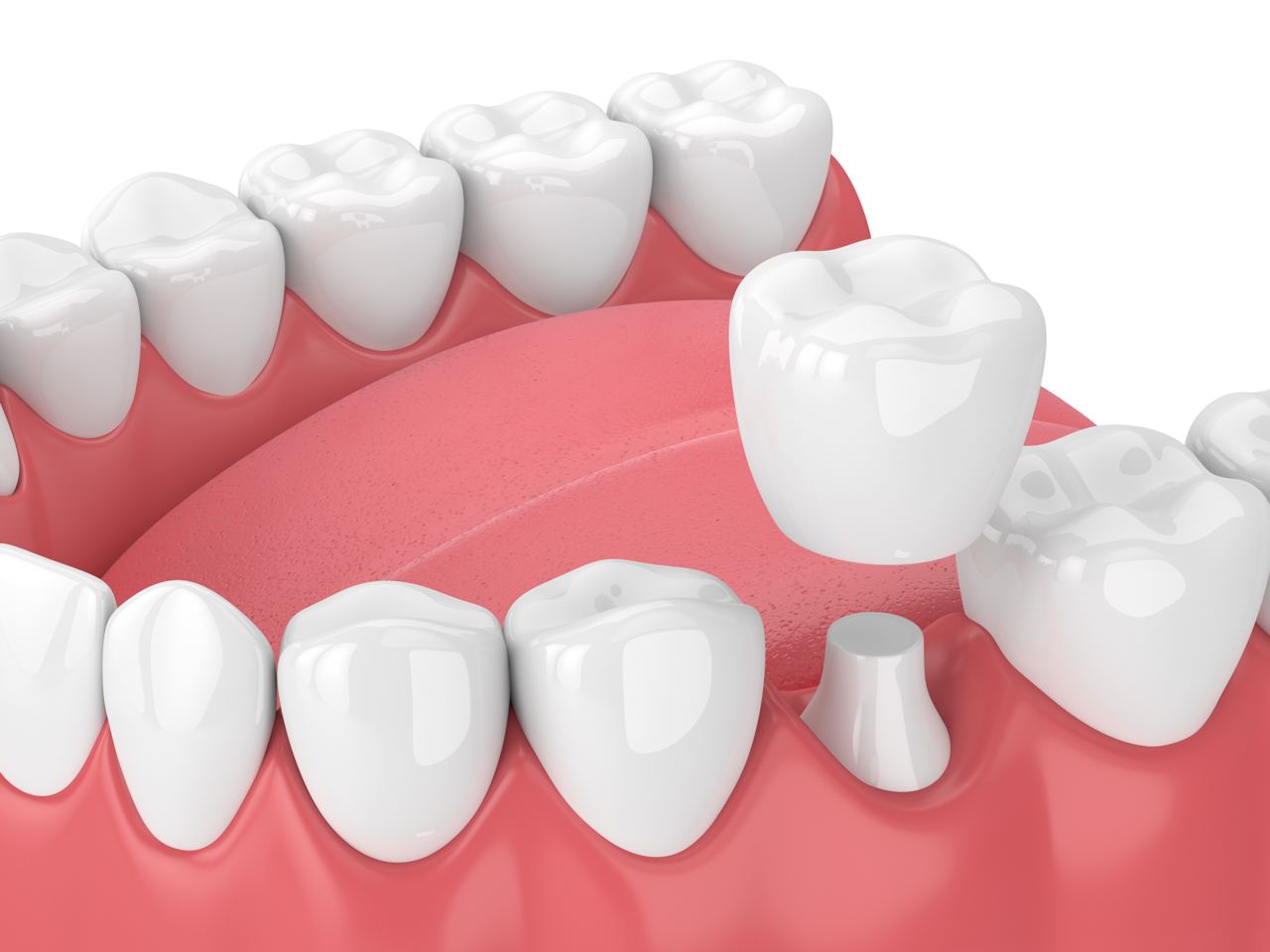 3d render of jaw with teeth and dental crown restoration in Surrey, BC