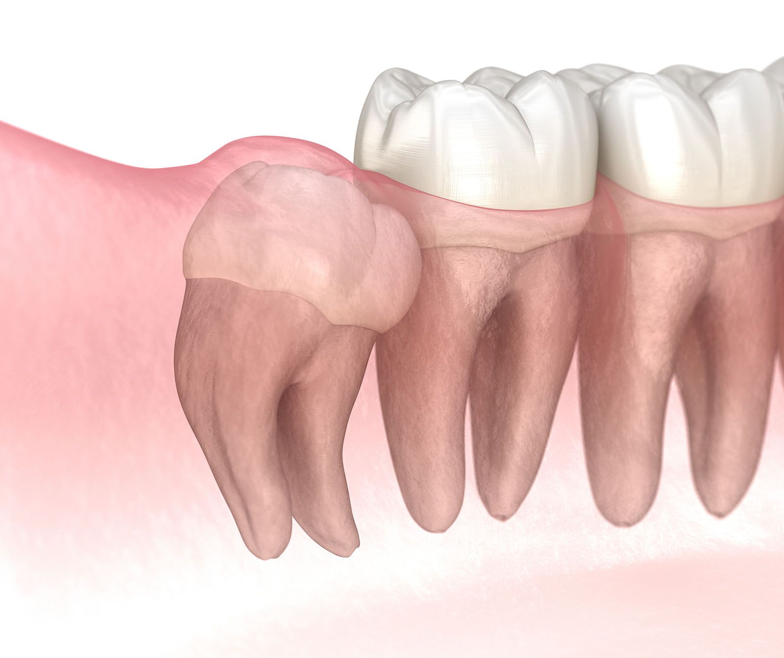 Illustration of an impacted tooth, suggesting wisdom teeth removal in Surrey, BC