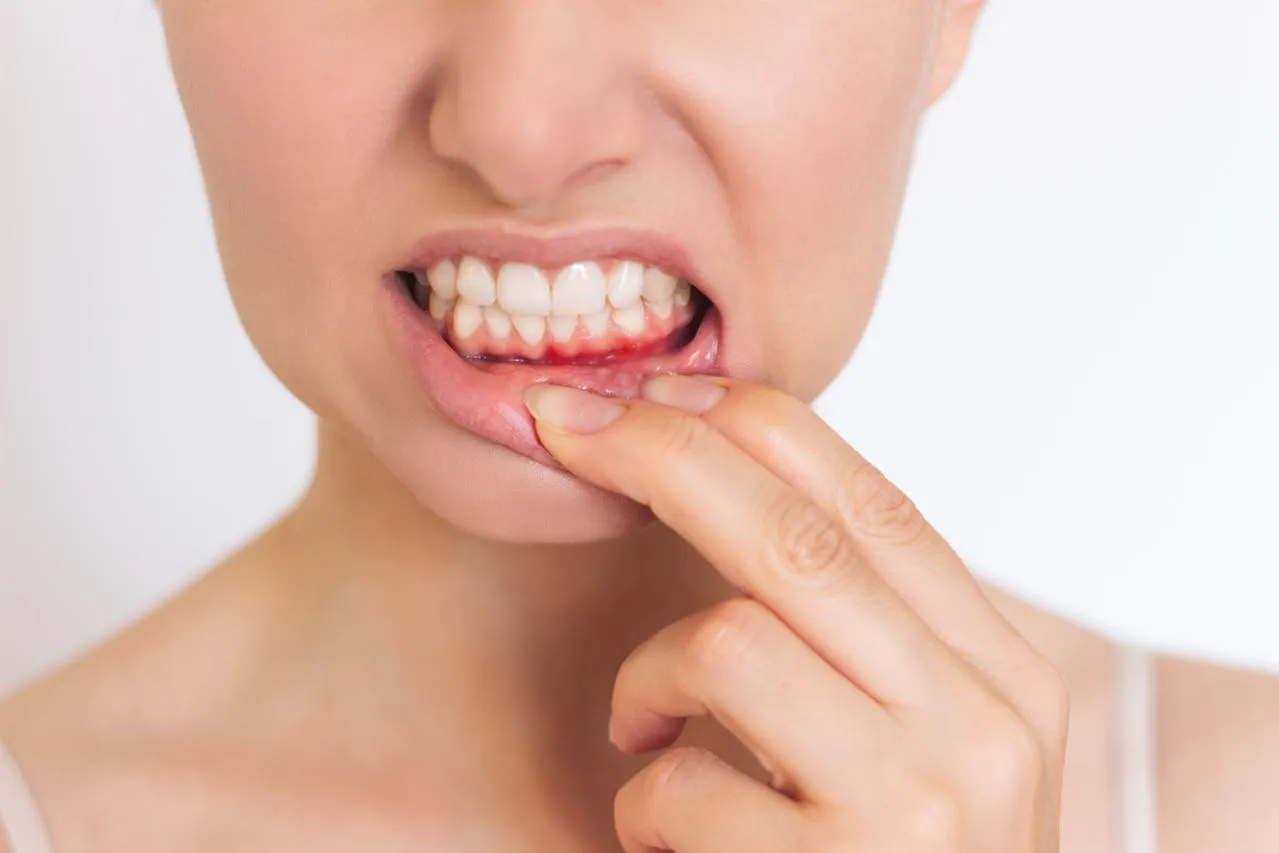 woman who suffers from inflammation of the gums on the lower jaw