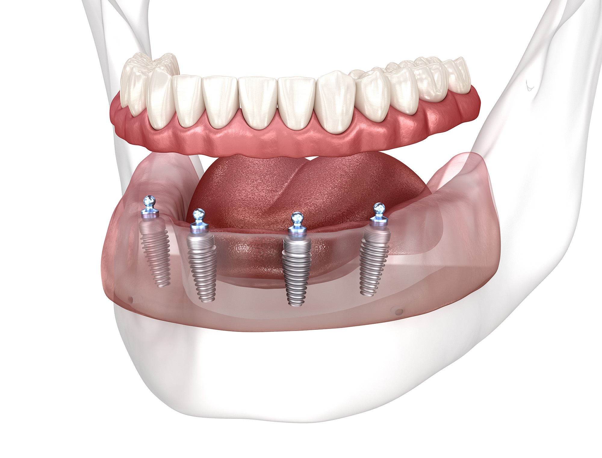 3D illustration of All-on-4 system supported by dental implants