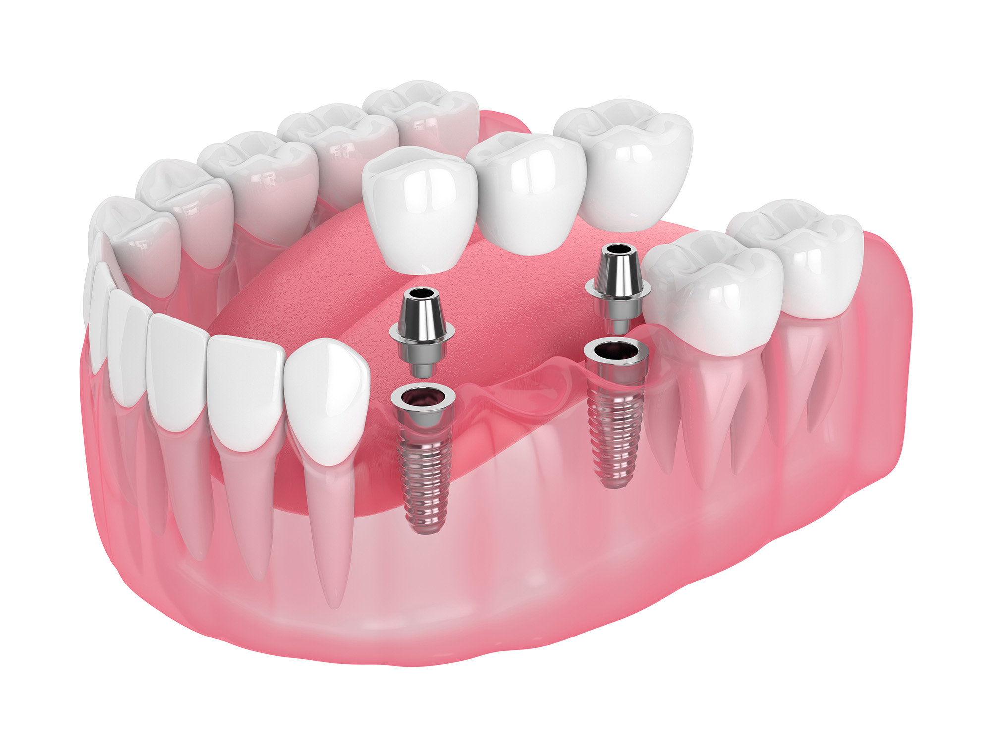 3d render of jaw with Multiple dental implants supported dental bridge