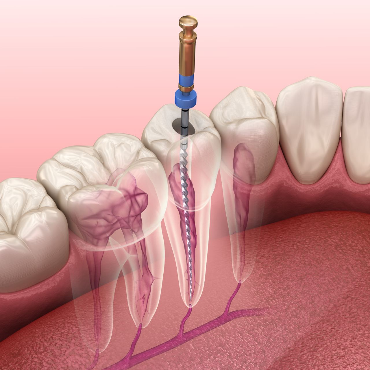 Endodontic root canal treatment process in Surrey, BC